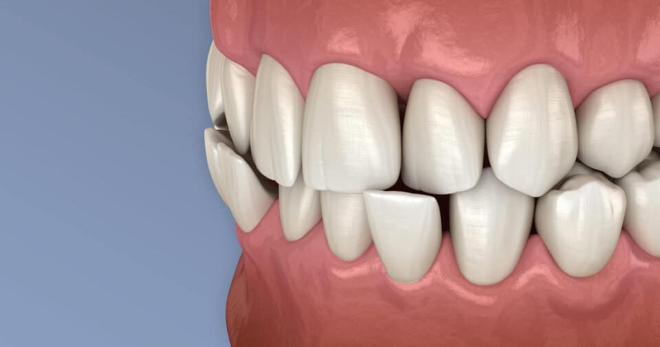 Crossbite Correction in San Antonio, TX | Bite Correction