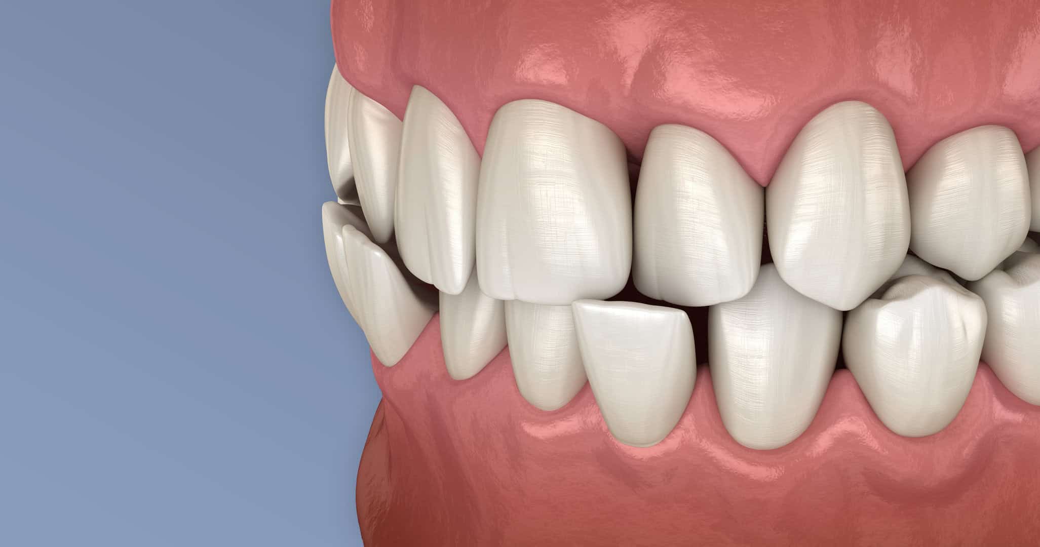 Cross Bitree Crossbite Correction in San Antonio, TX | Bite Correction